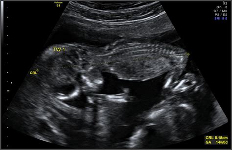 how accurate is a dating scan at 14 weeks